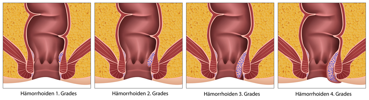 44++ Bilden sich haemorrhoiden zurueck , Krankheiten im Alter Hämorrhoiden I PflegeBox.de