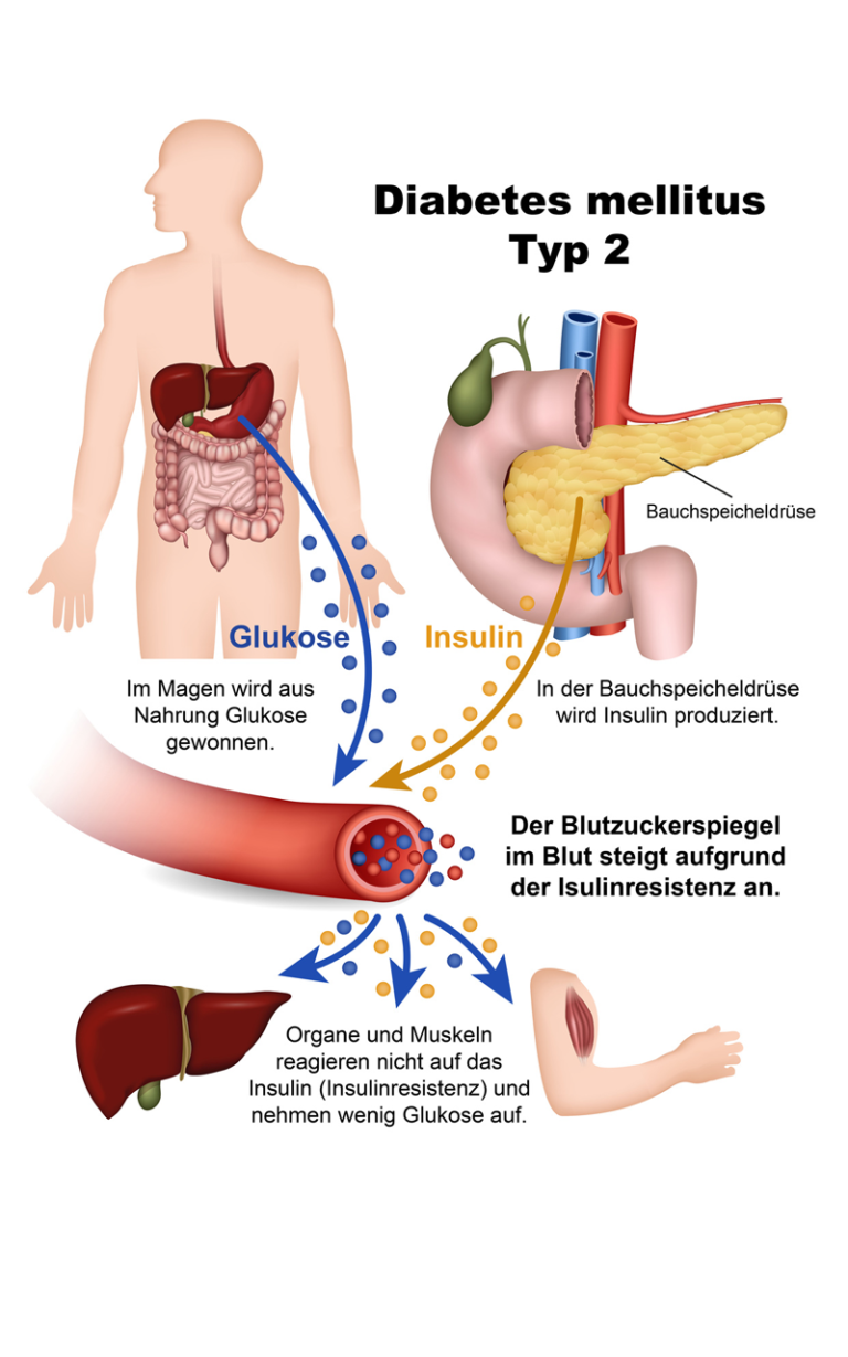 Diabetes Mellitus: Pflegediagnosen und Management