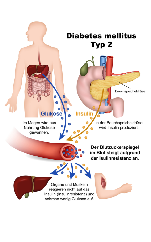 Krankheiten im Alter- Diabetes Typ 2 I PflegeBox.de
